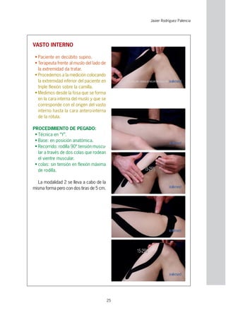 25
VASTO INTERNO
• Paciente en decúbito supino.
• Terapeuta frente al muslo del lado de
la extremidad da tratar.
• Procedemos a la medición colocando
la extremidad inferior del paciente en
triple flexión sobre la camilla.
• Medimos desde la fosa que se forma
en la cara interna del muslo y que se
corresponde con el origen del vasto
interno hasta la cara antero-interna
de la rótula.
PROCEDIMIENTO DE PEGADO:
• Técnica en “Y”.
• Base: en posición anatómica.
• Recorrido: rodilla 90º tensión muscu-
lar a través de dos colas que rodean
el vientre muscular.
• colas: sin tensión en flexión máxima
de rodilla.
La modalidad 2 se lleva a cabo de la
misma forma pero con dos tiras de 5 cm.
Javier Rodríguez Palencia
 