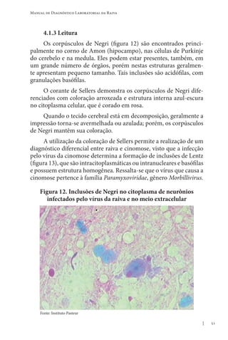 51
Manual de Diagnóstico Laboratorial da Raiva
4.1.3 Leitura
Os corpúsculos de Negri (figura 12) são encontrados princi-
palmente no corno de Amon (hipocampo), nas células de Purkinje
do cerebelo e na medula. Eles podem estar presentes, também, em
um grande número de órgãos, porém nestas estruturas geralmen-
te apresentam pequeno tamanho. Tais inclusões são acidófilas, com
granulações basófilas.
O corante de Sellers demonstra os corpúsculos de Negri dife-
renciados com coloração arroxeada e estrutura interna azul-escura
no citoplasma celular, que é corado em rosa.
Quando o tecido cerebral está em decomposição, geralmente a
impressão torna-se avermelhada ou azulada; porém, os corpúsculos
de Negri mantêm sua coloração.
A utilização da coloração de Sellers permite a realização de um
diagnóstico diferencial entre raiva e cinomose, visto que a infecção
pelo vírus da cinomose determina a formação de inclusões de Lentz
(figura 13), que são intracitoplasmáticas ou intranucleares e basófilas
e possuem estrutura homogênea. Ressalta-se que o vírus que causa a
cinomose pertence à família Paramyxoviridae, gênero Morbillivirus.
Figura 12. Inclusões de Negri no citoplasma de neurônios
infectados pelo vírus da raiva e no meio extracelular
Fonte: Instituto Pasteur
 