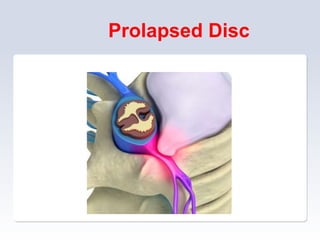 Prolapsed Disc
 