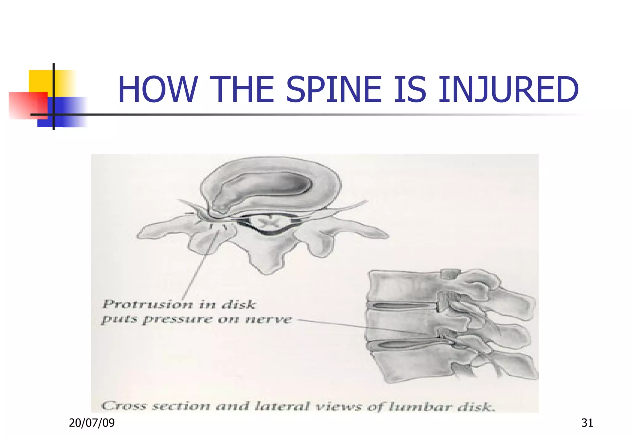 HOW THE SPINE IS INJURED




20/07/09                              31
 