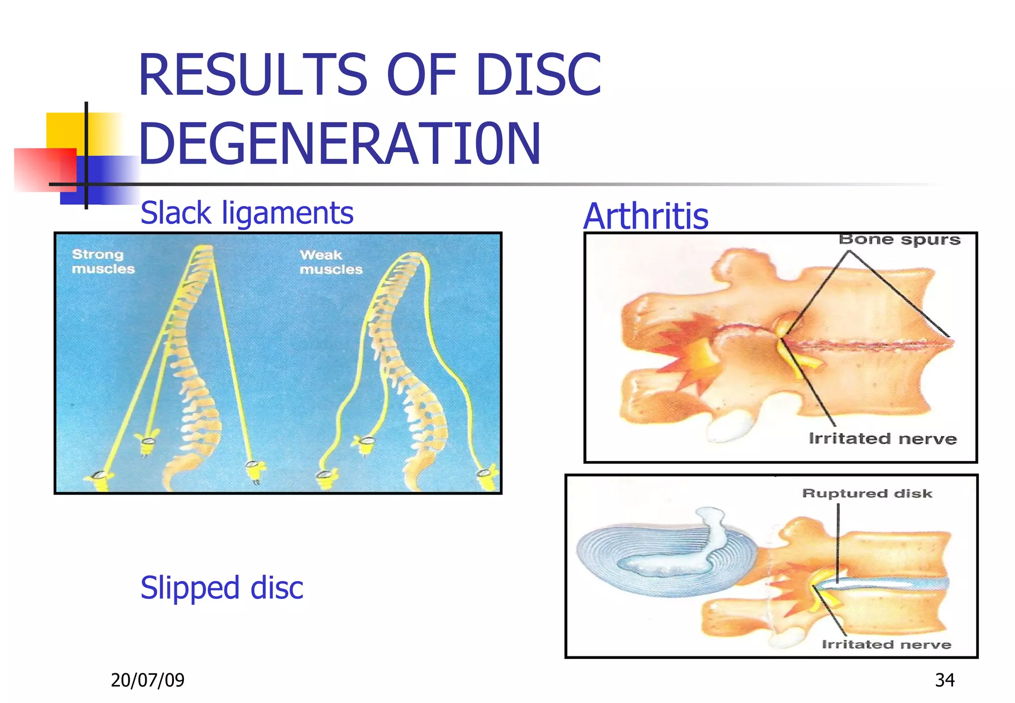 RESULTS OF DISC
  DEGENERATI0N
   Slack ligaments   Arthritis




   Slipped disc

20/07/09                         34
 