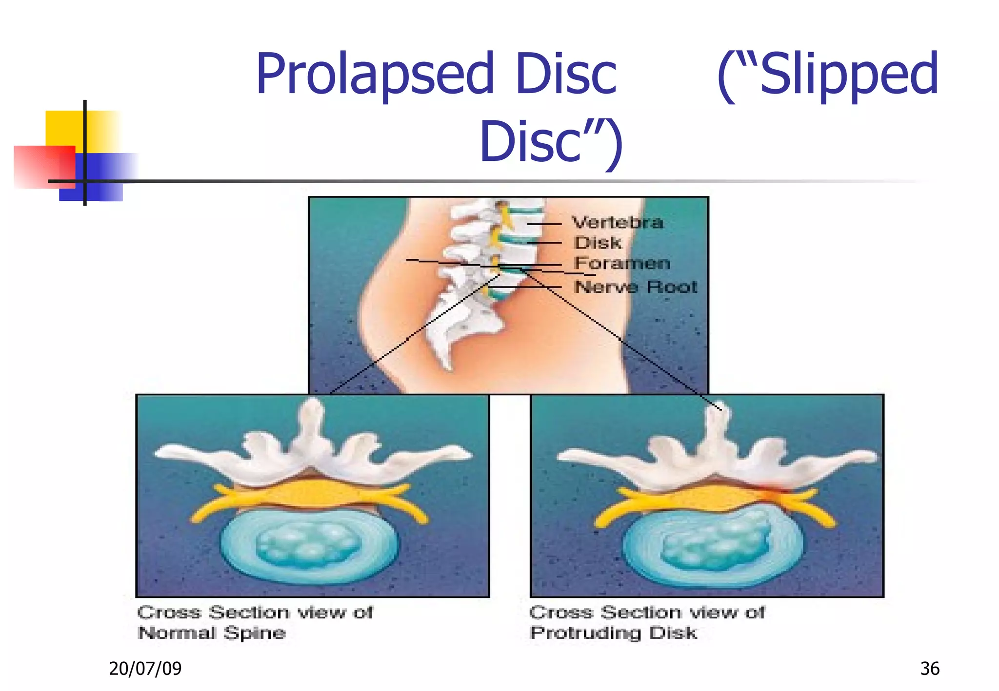 Prolapsed Disc   (“Slipped
                   Disc”)




20/07/09                            36
 