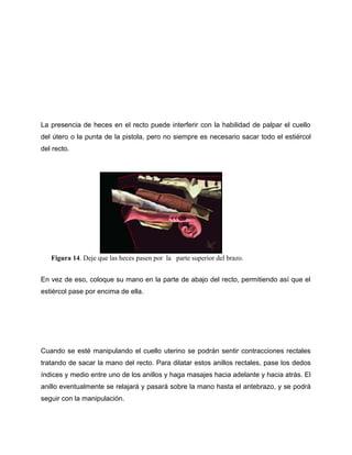 La presencia de heces en el recto puede interferir con la habilidad de palpar el cuello 
del útero o la punta de la pistola, pero no siempre es necesario sacar todo el estiércol 
del recto. 
Figura 14. Deje que las heces pasen por la parte superior del brazo. 
En vez de eso, coloque su mano en la parte de abajo del recto, permitiendo así que el 
estiércol pase por encima de ella. 
Cuando se esté manipulando el cuello uterino se podrán sentir contracciones rectales 
tratando de sacar la mano del recto. Para dilatar estos anillos rectales, pase los dedos 
índices y medio entre uno de los anillos y haga masajes hacia adelante y hacia atrás. El 
anillo eventualmente se relajará y pasará sobre la mano hasta el antebrazo, y se podrá 
seguir con la manipulación. 
 