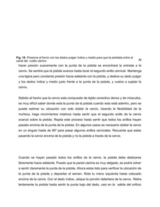 Al 
Fig. 16. Presione el fornix con los dedos pulgar índice y medio para que la pistoleta entre al 
canal del cuello uterino 
hacer presión suavemente con la punta de la pistola se encontrará la entrada a la 
cervix. Se sentirá que la pistola avanza hasta tocar el segundo anillo cervical. Mantenga 
una ligera pero constante presión hacia adelante con la pistola, y deslice su dedo pulgar 
y los dedos índice y medio justo frente a la punta de la pistola, y vuelva a sujetar la 
cervix. 
Debido al hecho que la cervix esta compuesto de tejido conectivo denso y de músculos, 
es muy difícil saber donde esta la punta de la pistola cuando esta está adentro, pero se 
puede estimar su ubicación con solo doblar la cervix. Usando la flexibilidad de la 
muñeca, haga movimientos rotativos hasta sentir que el segundo anillo de la cervix 
avanzó sobre la pistola. Repita este proceso hasta sentir que todos los anillos hayan 
pasado encima de la punta de la pistola. En algunos casos es necesario doblar la cervix 
en un ángulo hasta de 90º para pasar algunos anillos cervicales. Recuerda que estas 
pasando la cervix encima de la pistola y no la pistola a través de la cervix. 
Cuando se hayan pasado todos los anillos de la cervix, la pistola debe deslizarse 
libremente hacia adelante. Puesto que la pared uterina es muy delgada, se podrá volver 
a sentir claramente la punta de la pistola. Ahora estas listo para verificar la ubicación de 
la punta de la pistola y depositar el semen. Rota tu mano izquierda hasta colocarlo 
encima de la cervix. Con el dedo índice, ubique la porción delantera de la cervix. Retire 
lentamente la pistola hasta sentir la punta bajo del dedo, casi en la salida del orificio 
 
