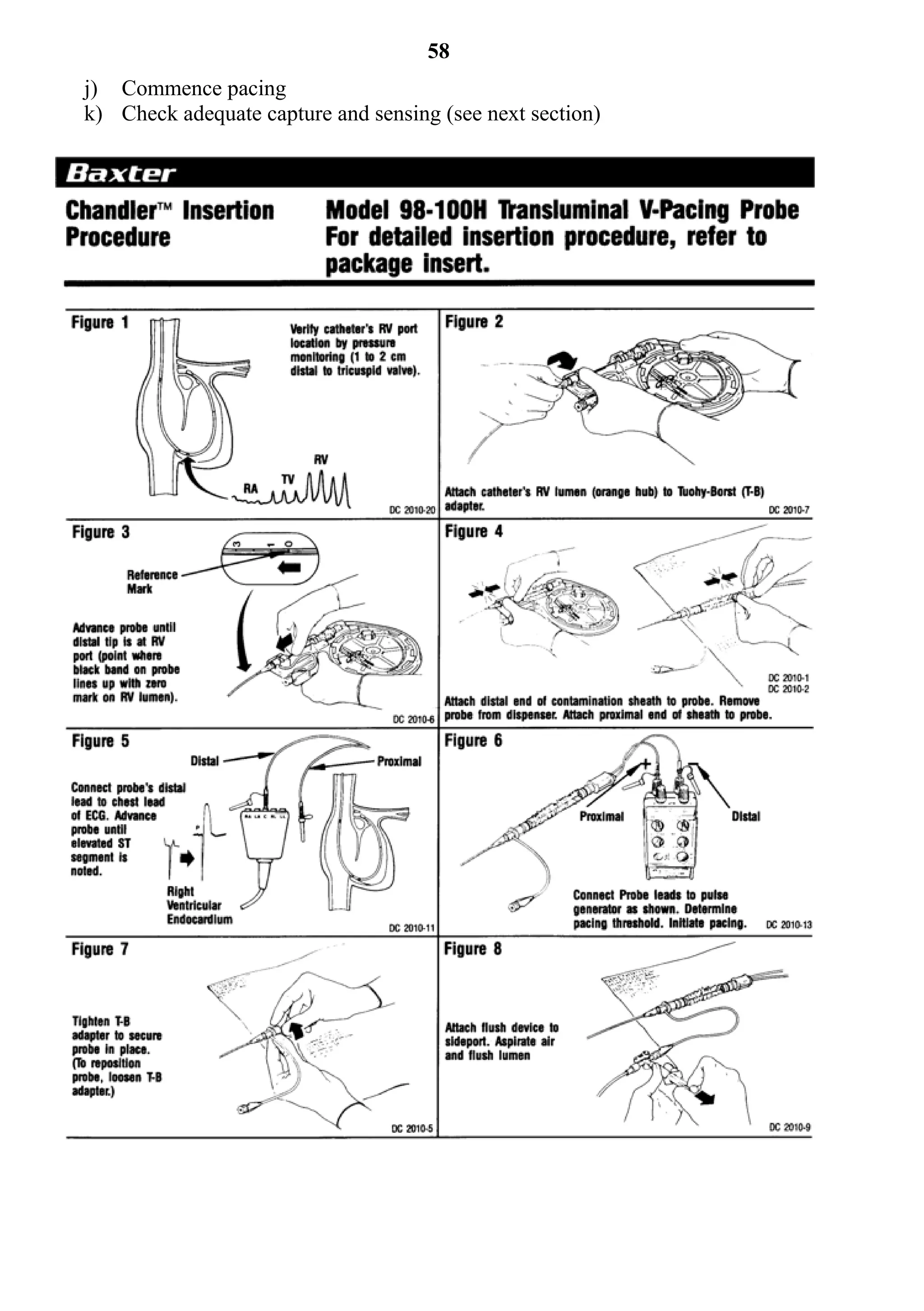 58
j) Commence pacing
k) Check adequate capture and sensing (see next section)
 