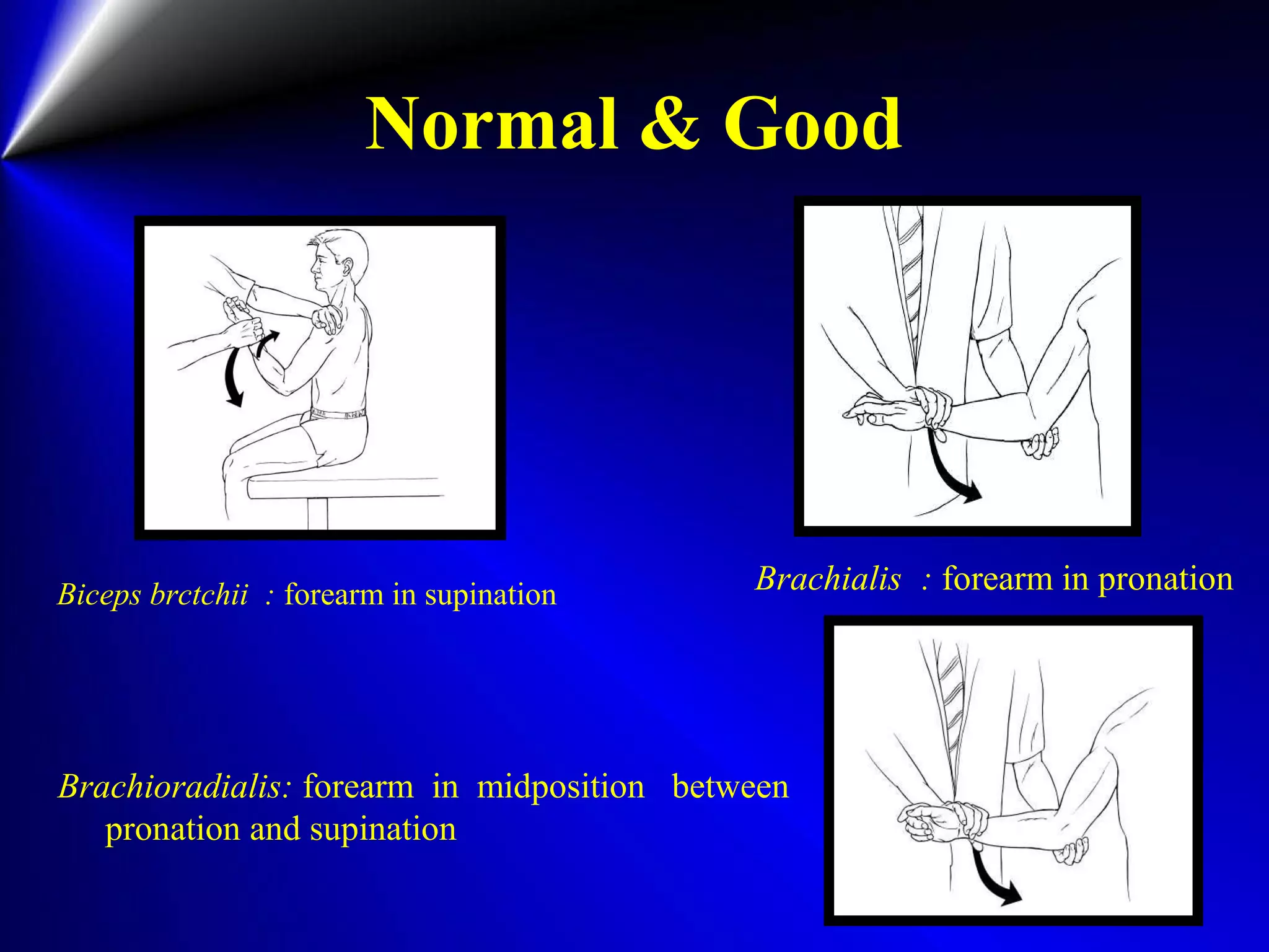 Normal & Good
Brachioradialis: forearm in midposition between
pronation and supination
Biceps brctchii : forearm in supination Brachialis : forearm in pronation
 