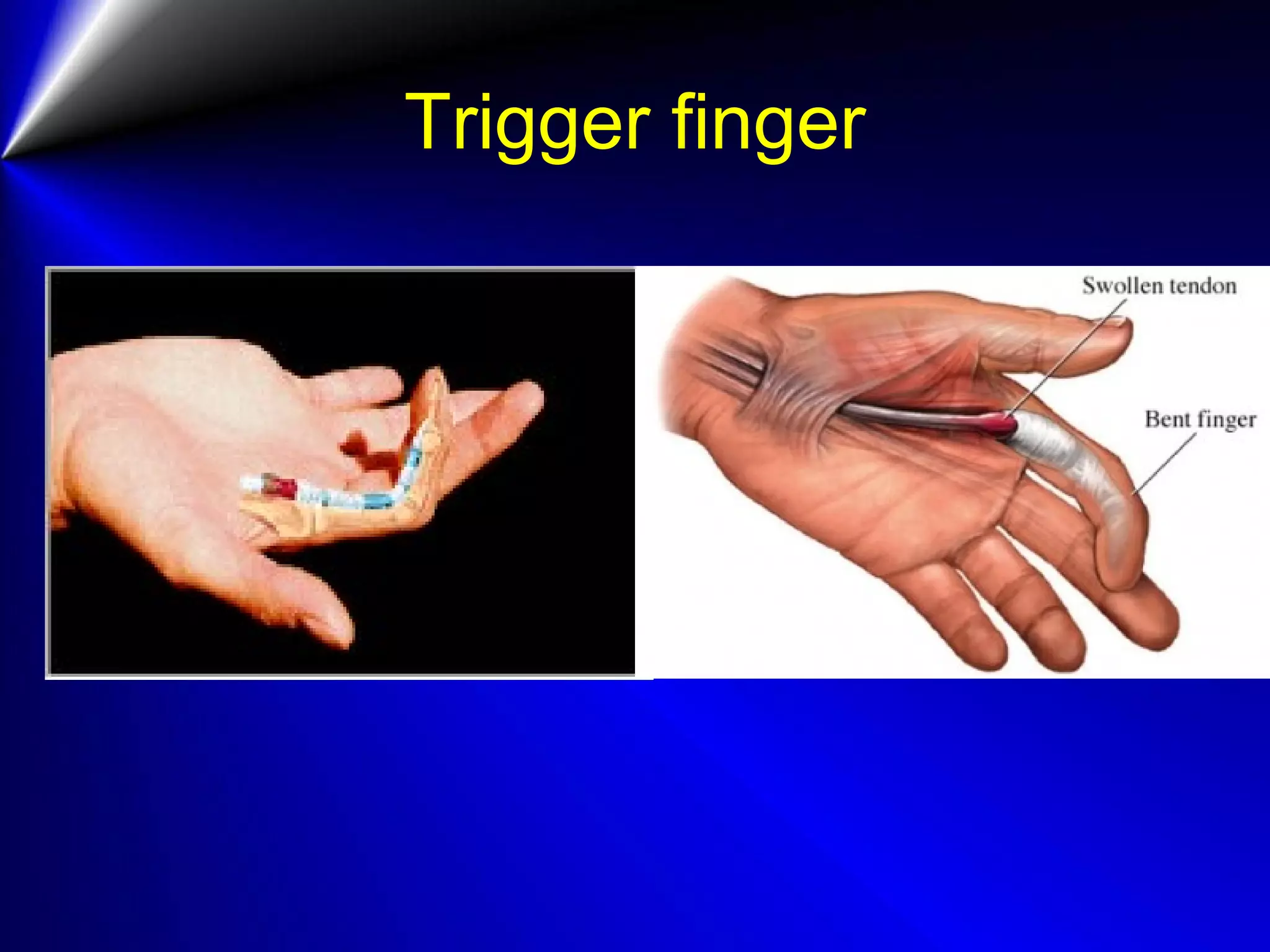 Trigger finger
 