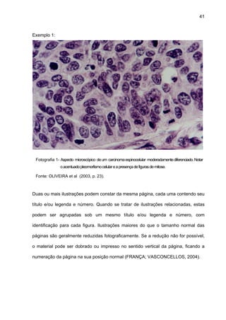 41



Exemplo 1:




 Fotografia 1- Aspecto microscópico de um carcinoma espinocelular moderadamente diferenciado. Notar
               o acentuado pleomorfismo celular e a presença de figuras de mitose.

 Fonte: OLIVEIRA et al (2003, p. 23).



Duas ou mais ilustrações podem constar da mesma página, cada uma contendo seu

título e/ou legenda e número. Quando se tratar de ilustrações relacionadas, estas

podem ser agrupadas sob um mesmo título e/ou legenda e número, com

identificação para cada figura. Ilustrações maiores do que o tamanho normal das

páginas são geralmente reduzidas fotograficamente. Se a redução não for possível,

o material pode ser dobrado ou impresso no sentido vertical da página, ficando a

numeração da página na sua posição normal (FRANÇA; VASCONCELLOS, 2004).
 