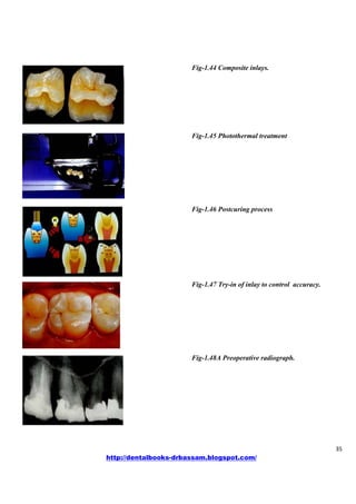 Manual of operitive dentistry | PDF