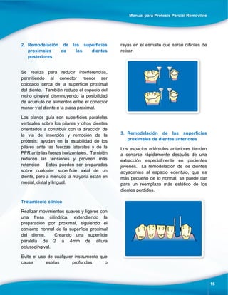 Manual para Prótesis Parcial Removible
16
2. Remodelación de las superficies
proximales de los dientes
posteriores
Se realiza para reducir interferencias,
permitiendo al conector menor ser
colocado cerca de la superficie proximal
del diente. También reduce el espacio del
nicho gingival disminuyendo la posibilidad
de acumulo de alimentos entre el conector
menor y el diente o la placa proximal.
Los planos guía son superficies paralelas
verticales sobre los pilares y otros dientes
orientados a contribuir con la dirección de
la vía de inserción y remoción de la
prótesis; ayudan en la estabilidad de los
pilares ante las fuerzas laterales y de la
PPR ante las fueras horizontales. También
reducen las tensiones y proveen más
retención Estos pueden ser preparados
sobre cualquier superficie axial de un
diente, pero a menudo la mayoría están en
mesial, distal y lingual.
Tratamiento clínico
Realizar movimientos suaves y ligeros con
una fresa cilíndrica, extendiendo la
preparación por proximal, siguiendo el
contorno normal de la superficie proximal
del diente. Creando una superficie
paralela de 2 a 4mm de altura
oclusogingival.
Evite el uso de cualquier instrumento que
cause estrías profundas o
rayas en el esmalte que serán difíciles de
retirar.
3. Remodelación de las superficies
proximales de dientes anteriores
Los espacios edéntulos anteriores tienden
a cerrarse rápidamente después de una
extracción especialmente en pacientes
jóvenes. La remodelación de los dientes
adyacentes al espacio edéntulo, que es
más pequeño de lo normal, se puede dar
para un reemplazo más estético de los
dientes perdidos.
 