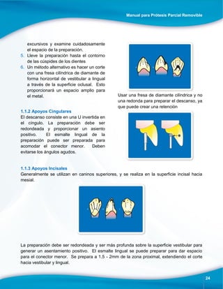 Manual para Prótesis Parcial Removible
24
excursivos y examine cuidadosamente
el espacio de la preparación.
5. Lleve la preparación hasta el contorno
de las cúspides de los dientes
6. Un método alternativo es hacer un corte
con una fresa cilíndrica de diamante de
forma horizontal de vestibular a lingual
a través de la superficie oclusal. Esto
proporcionará un espacio amplio para
el metal.
1.1.2 Apoyos Cingulares
El descanso consiste en una U invertida en
el cíngulo. La preparación debe ser
redondeada y proporcionar un asiento
positivo. El esmalte lingual de la
preparación puede ser preparada para
acomodar el conector menor. Deben
evitarse los ángulos agudos.
Usar una fresa de diamante cilíndrica y no
una redonda para preparar el descanso, ya
que puede crear una retención
1.1.3 Apoyos Incisales
Generalmente se utilizan en caninos superiores, y se realiza en la superficie incisal hacia
mesial.
La preparación debe ser redondeada y ser más profunda sobre la superficie vestibular para
generar un asentamiento positivo. El esmalte lingual se puede preparar para dar espacio
para el conector menor. Se prepara a 1.5 - 2mm de la zona proximal, extendiendo el corte
hacia vestibular y lingual.
 