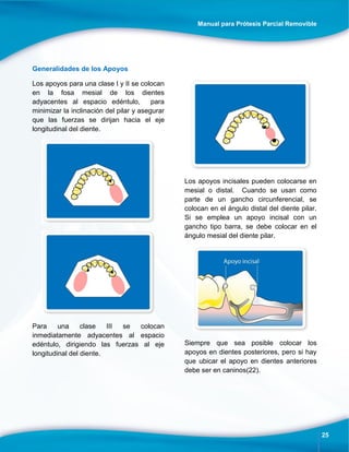 Manual para Prótesis Parcial Removible
25
Generalidades de los Apoyos
Los apoyos para una clase I y II se colocan
en la fosa mesial de los dientes
adyacentes al espacio edéntulo, para
minimizar la inclinación del pilar y asegurar
que las fuerzas se dirijan hacia el eje
longitudinal del diente.
Para una clase III se colocan
inmediatamente adyacentes al espacio
edéntulo, dirigiendo las fuerzas al eje
longitudinal del diente.
Los apoyos incisales pueden colocarse en
mesial o distal. Cuando se usan como
parte de un gancho circunferencial, se
colocan en el ángulo distal del diente pilar.
Si se emplea un apoyo incisal con un
gancho tipo barra, se debe colocar en el
ángulo mesial del diente pilar.
Siempre que sea posible colocar los
apoyos en dientes posteriores, pero si hay
que ubicar el apoyo en dientes anteriores
debe ser en caninos(22).
 