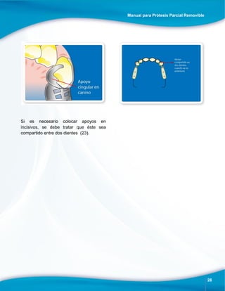 Manual para Prótesis Parcial Removible
26
Si es necesario colocar apoyos en
incisivos, se debe tratar que éste sea
compartido entre dos dientes (23).
 