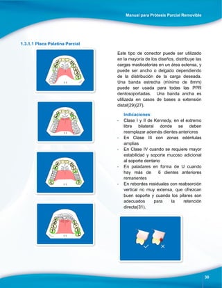 Manual para Prótesis Parcial Removible
30
1.3.1.1 Placa Palatina Parcial
Este tipo de conector puede ser utilizado
en la mayoría de los diseños, distribuye las
cargas masticatorias en un área extensa, y
puede ser ancho o delgado dependiendo
de la distribución de la carga deseada.
Una banda estrecha (mínimo de 8mm)
puede ser usada para todas las PPR
dentosoportadas. Una banda ancha es
utilizada en casos de bases a extensión
distal(29)(27).
Indicaciones:
- Clase I y II de Kennedy, en el extremo
libre bilateral donde se deben
reemplazar además dientes anteriores
- En Clase III con zonas edéntulas
amplias
- En Clase IV cuando se requiere mayor
estabilidad y soporte mucoso adicional
al soporte dentario
- En paladares en forma de U cuando
hay más de 6 dientes anteriores
remanentes
- En rebordes residuales con reabsorción
vertical no muy extensa, que ofrezcan
buen soporte y cuando los pilares son
adecuados para la retención
directa(31).
 