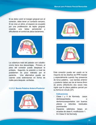 Manual para Prótesis Parcial Removible
31
Si se debe cubrir el margen gingival con el
conector, debe tener un contacto cercano.
Si se crea un alivio, el espacio es ocupado
por una proliferación de tejido gingival,
creando una bolsa periodontal y
dificultando el control de placa bacteriana.
La cobertura total del paladar con cobalto-
cromo tiene dos desventajas. Primero, el
peso del conector puede desplazar la
prótesis. Segundo, la posición a nivel de
postdamen es poco tolerado por el
paciente. Una alternativa puede ser
usando unas extensiones en forma de
malla para después acriladas.
1.3.1.2 Banda Palatina Antero-Posterior
Este conector puede ser usado en la
mayoría de los diseños de PPR maxilar
y especialmente cuando hay presencia
de torus palatino. Las bandas anterior
y posterior deben ser de al menos 8mm
de ancho (29)(32).Es dos veces más
rígido que la placa palatina parcial por
su forma en círculo (27).
Indicaciones
- Clase I y II de Kennedy casos
dentosoportados o
dentomucosoportados con buenos
pilares y rebordes residuales
prominentes
- Espacios edéntulos largos en
arcadas de clase II, modificación 1.
- En Clase IV de Kennedy
 