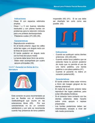 Manual para Prótesis Parcial Removible
35
Indicaciones
- Clase III con espacios edéntulos
amplios
- Clase I y II con buenos rebordes
residuales y con pilares fuertes sin
problemas para la retención indirecta
para una prótesis dentosoportada
- Paladares ovales (37) (38) (39).
Características
- Reproducción anatómica
- En el borde anterior, sigue los valles
entre las rugas y en ángulo recto con
la línea de sutura media
- El borde posterior en ángulo recto
con la línea de sutura media
- La banda debe tener 8mm de ancho
- Debe estar acompañada por cuatro
apoyos principales (39).
1.3.1.7 Conector en forma de U o
Herradura
Este conector es poco recomendado ya
que es flexible con el movimiento
vestibulolingual que ocurre en las
extensiones libres (29). Por sus
características no es un conector
satisfactorio y por solo se recomienda
cuando hay presencia de torus palatino
inoperable (40) (41). Si se usa debe
ser diseñado tan corto como sea
posible (42).
Indicaciones
- Cuando se sustituyen varios dientes
anteriores (43) (44) (45).
- Cuando existe torus palatino que se
extiende hacia la porción posterior
de modo que no permita el uso de
una barra palatina, una banda
palatina o una placa palatina (41).
- Cuando el paciente no tolera un
conector posterior(46).
Características
- El borde anterior debe estar mínimo
a 6mm del margen gingival de los
dientes anteriores
- El metal de la porción anterior debe
reproducir las rugas palatinas, para
evitar dificultades fonéticas
- Si el conector hace contacto con los
dientes anteriores debe hacerlo
sobre unos apoyos o repisas
preparadas
- Los bordes posteriores deben ser
redondeados, excepto a nivel del
rafe medio prominente
 