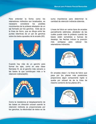 Manual para Prótesis Parcial Removible
44
Para entender la forma como los
retenedores indirectos son localizados, es
necesario considerar los posibles
movimientos de la prótesis alrededor de un
eje formado por los ganchos. Este eje es
la línea de fulcro, que se dibuja entre las
puntas retentivas de un par de ganchos
sobre los lados opuestos de la arcada (62).
Cuando hay más de un gancho para
formar los ejes, como en esta clase
Kennedy III, es el gancho más cercano a
las bases la que contribuyen más a la
retención indirecta(62).
Como la resistencia al desplazamiento de
las bases en dirección oclusal usando la
retención indirecta es proporcionada por
los ganchos, la efectividad de éstos es de
suma importancia para determinar la
cantidad de retención indirecta obtenida.
Líneas de fulcro en varios tipos de arcadas
parcialmente edéntulas, alrededor de las
cuales puede rotar la prótesis cuando las
bases están sometidas a fuerzas de
desalojo, las flechas indican la posición
más ventajosa para colocar los
retenedores indirectos:
En arcadas clase I, la línea de fulcro que
pasa por los pilares más posteriores
proporciona algún componente rígido si
queda por oclusal de de la línea de
máximo contorno de los pilares (61).
 