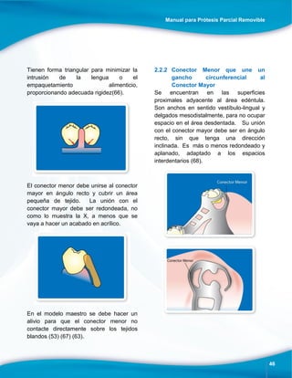 Manual para Prótesis Parcial Removible
46
Tienen forma triangular para minimizar la
intrusión de la lengua o el
empaquetamiento alimenticio,
proporcionando adecuada rigidez(66).
El conector menor debe unirse al conector
mayor en ángulo recto y cubrir un área
pequeña de tejido. La unión con el
conector mayor debe ser redondeada, no
como lo muestra la X, a menos que se
vaya a hacer un acabado en acrílico.
En el modelo maestro se debe hacer un
alivio para que el conector menor no
contacte directamente sobre los tejidos
blandos (53) (67) (63).
2.2.2 Conector Menor que une un
gancho circunferencial al
Conector Mayor
Se encuentran en las superficies
proximales adyacente al área edéntula.
Son anchos en sentido vestíbulo-lingual y
delgados mesodistalmente, para no ocupar
espacio en el área desdentada. Su unión
con el conector mayor debe ser en ángulo
recto, sin que tenga una dirección
inclinada. Es más o menos redondeado y
aplanado, adaptado a los espacios
interdentarios (68).
 