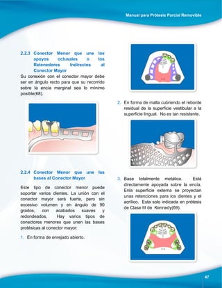 Manual para Prótesis Parcial Removible
47
2.2.3 Conector Menor que une los
apoyos oclusales o los
Retenedores Indirectos al
Conector Mayor
Su conexión con el conector mayor debe
ser en ángulo recto para que su recorrido
sobre la encía marginal sea lo mínimo
posible(68).
2.2.4 Conector Menor que une las
bases al Conector Mayor
Este tipo de conector menor puede
soportar varios dientes. La unión con el
conector mayor será fuerte, pero sin
excesivo volumen y en ángulo de 90
grados, con acabados suaves y
redondeados. Hay varios tipos de
conectores menores que unen las bases
protésicas al conector mayor:
1. En forma de enrejado abierto.
2. En forma de malla cubriendo el reborde
residual de la superficie vestibular a la
superficie lingual. No es tan resistente.
3. Base totalmente metálica. Está
directamente apoyada sobre la encía.
Enla superficie externa se proyectan
unas retenciones para los dientes y el
acrílico. Esta solo indicada en prótesis
de Clase III de Kennedy(69).
 