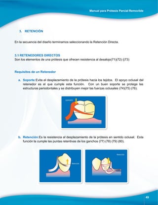 Manual para Prótesis Parcial Removible
49
3. RETENCIÓN
En la secuencia del diseño terminamos seleccionando la Retención Directa.
3.1 RETENEDORES DIRECTOS
Son los elementos de una prótesis que ofrecen resistencia al desalojo(71)(72) {(73)
Requisitos de un Retenedor
a. Soporte:Evita el desplazamiento de la prótesis hacia los tejidos. El apoyo oclusal del
retenedor es el que cumple esta función. Con un buen soporte se protege las
estructuras periodontales y se distribuyen mejor las fuerzas oclusales (74)(75) (76).
b. Retención:Es la resistencia al desplazamiento de la prótesis en sentido oclusal. Esta
función la cumple las puntas retentivas de los ganchos (77) (78) (79) (80).
 
