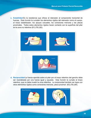 Manual para Prótesis Parcial Removible
50
c. Estabilidad:Es la resistencia que ofrece el retenedor al componente horizontal de
fuerzas. Esta función la cumplen los elementos rígidos del retenedor como el cuerpo,
el brazo estabilizador, los apoyos oclusales, los conectores menores y las placas
proximales. Todos estos elementos rígidos hacen contacto con la superficie del pilar
en la zona no retentiva (81) (76) (82).
d. Reciprocidad:La fuerza ejercida sobre el pilar por el brazo retentivo del gancho debe
ser neutralizada por una fuerza igual y opuesta. Esta función la cumple el brazo
retentivo, que no debe invadir la zona retentiva. La reciprocidad también ser logra con
otros elementos rígidos como conectores menores, placa proximal (83) (76) (84).
 