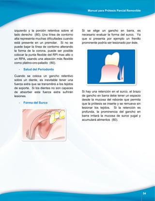 Manual para Prótesis Parcial Removible
54
izquierdo y la porción retentiva sobre el
lado derecho (80). Una línea de contorno
alta representa muchas dificultades cuando
está presente en un premolar. Si no se
puede bajar la línea de contorno alterando
la forma de la corona, puede ser posible
colocar la punta flexible del RPI mas alto o
un RPA, usando una aleación más flexible
como platino-oro-paladio (80).
- Salud del Periodonto
Cuando se coloca un gancho retentivo
sobre un diente, es inevitable tener una
fuerza extra que se transmitirá a los tejidos
de soporte. Si los dientes no son capaces
de absorber esta fuerza extra sufrirán
lesiones.
- Forma del Surco
Si se elige un gancho en barra, es
necesario evaluar la forma del surco. Ya
que si presenta por ejemplo un frenillo
prominente podría ser lesionado por éste.
Si hay una retención en el surco, el brazo
de gancho en barra debe tener un espacio
desde la mucosa del reborde que permita
que la prótesis se inserte y se remueva sin
lesionar los tejidos. Si la retención es
profunda, la prominencia del gancho en
barra irritará la mucosa de surco yugal y
acumulará alimentos (80).
 