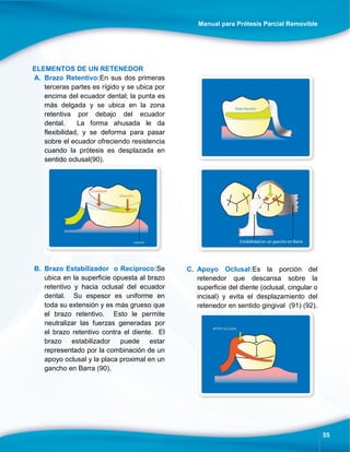 Manual para Prótesis Parcial Removible
55
ELEMENTOS DE UN RETENEDOR
A. Brazo Retentivo:En sus dos primeras
terceras partes es rígido y se ubica por
encima del ecuador dental; la punta es
más delgada y se ubica en la zona
retentiva por debajo del ecuador
dental. La forma ahusada le da
flexibilidad, y se deforma para pasar
sobre el ecuador ofreciendo resistencia
cuando la prótesis es desplazada en
sentido oclusal(90).
B. Brazo Estabilizador o Recíproco:Se
ubica en la superficie opuesta al brazo
retentivo y hacia oclusal del ecuador
dental. Su espesor es uniforme en
toda su extensión y es más grueso que
el brazo retentivo. Esto le permite
neutralizar las fuerzas generadas por
el brazo retentivo contra el diente. El
brazo estabilizador puede estar
representado por la combinación de un
apoyo oclusal y la placa proximal en un
gancho en Barra (90).
C. Apoyo Oclusal:Es la porción del
retenedor que descansa sobre la
superficie del diente (oclusal, cingular o
incisal) y evita el desplazamiento del
retenedor en sentido gingival (91) (92).
 