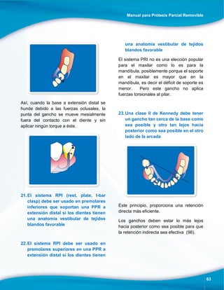 Manual para Prótesis Parcial Removible
63
Así, cuando la base a extensión distal se
hunde debido a las fuerzas oclusales, la
punta del gancho se mueve mesialmente
fuera del contacto con el diente y sin
aplicar ningún torque a éste.
21.El sistema RPI (rest, plate, I-bar
clasp) debe ser usado en premolares
inferiores que soportan una PPR a
extensión distal si los dientes tienen
una anatomía vestibular de tejidos
blandos favorable
22.El sistema RPI debe ser usado en
premolares superiores en una PPR a
extensión distal si los dientes tienen
una anatomía vestibular de tejidos
blandos favorable
El sistema PRI no es una elección popular
para el maxilar como lo es para la
mandíbula, posiblemente porque el soporte
en el maxilar es mayor que en la
mandíbula, es decir el déficit de soporte es
menor. Pero este gancho no aplica
fuerzas torsionales al pilar.
23.Una clase II de Kennedy debe tener
un gancho tan cerca de la base como
sea posible y otro tan lejos hacia
posterior como sea posible en el otro
lado de la arcada
Este principio, proporciona una retención
directa más eficiente.
Los ganchos deben estar lo más lejos
hacia posterior como sea posible para que
la retención indirecta sea efectiva (98).
 