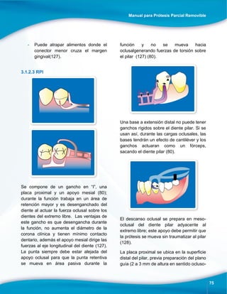 Manual para Prótesis Parcial Removible
75
- Puede atrapar alimentos donde el
conector menor cruza el margen
gingival(127).
3.1.2.3 RPI
Se compone de un gancho en “I”, una
placa proximal y un apoyo mesial (80);
durante la función trabaja en un área de
retención mayor y es desenganchado del
diente al actuar la fuerza oclusal sobre los
dientes del extremo libre. Las ventajas de
este gancho es que desengancha durante
la función, no aumenta el diámetro de la
corona clínica y tienen mínimo contacto
dentario, además el apoyo mesial dirige las
fuerzas al eje longitudinal del diente (127).
La punta siempre debe estar alejada del
apoyo oclusal para que la punta retentiva
se mueva en área pasiva durante la
función y no se mueva hacia
oclusalgenerando fuerzas de torsión sobre
el pilar (127) (80).
Una base a extensión distal no puede tener
ganchos rígidos sobre el diente pilar. Si se
usan así, durante las cargas oclusales, las
bases tendrán un efecto de cantiléver y los
ganchos actuaran como un fórceps,
sacando el diente pilar (80).
El descanso oclusal se prepara en meso-
oclusal del diente pilar adyacente al
extremo libre; este apoyo debe permitir que
la prótesis se mueva sin traumatizar al pilar
(128).
La placa proximal se ubica en la superficie
distal del pilar, previa preparación del plano
guía (2 a 3 mm de altura en sentido ocluso-
 