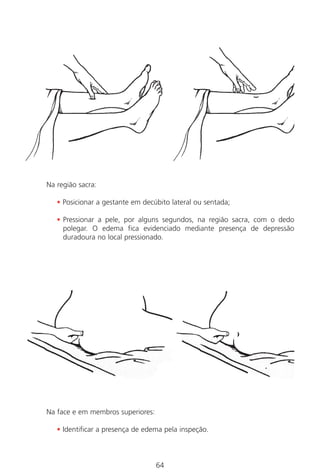 64
Na região sacra:
• Posicionar a gestante em decúbito lateral ou sentada;
• Pressionar a pele, por alguns segundos, na região sacra, com o dedo
polegar. O edema fica evidenciado mediante presença de depressão
duradoura no local pressionado.
Na face e em membros superiores:
• Identificar a presença de edema pela inspeção.
Manual Puerpério 19/09/06.indd 64 11/1/06 7:03:54 PM
 