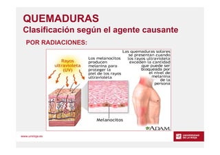 www.unirioja.es
QUEMADURAS
Clasificación según el agente causante
POR RADIACIONES:
 
