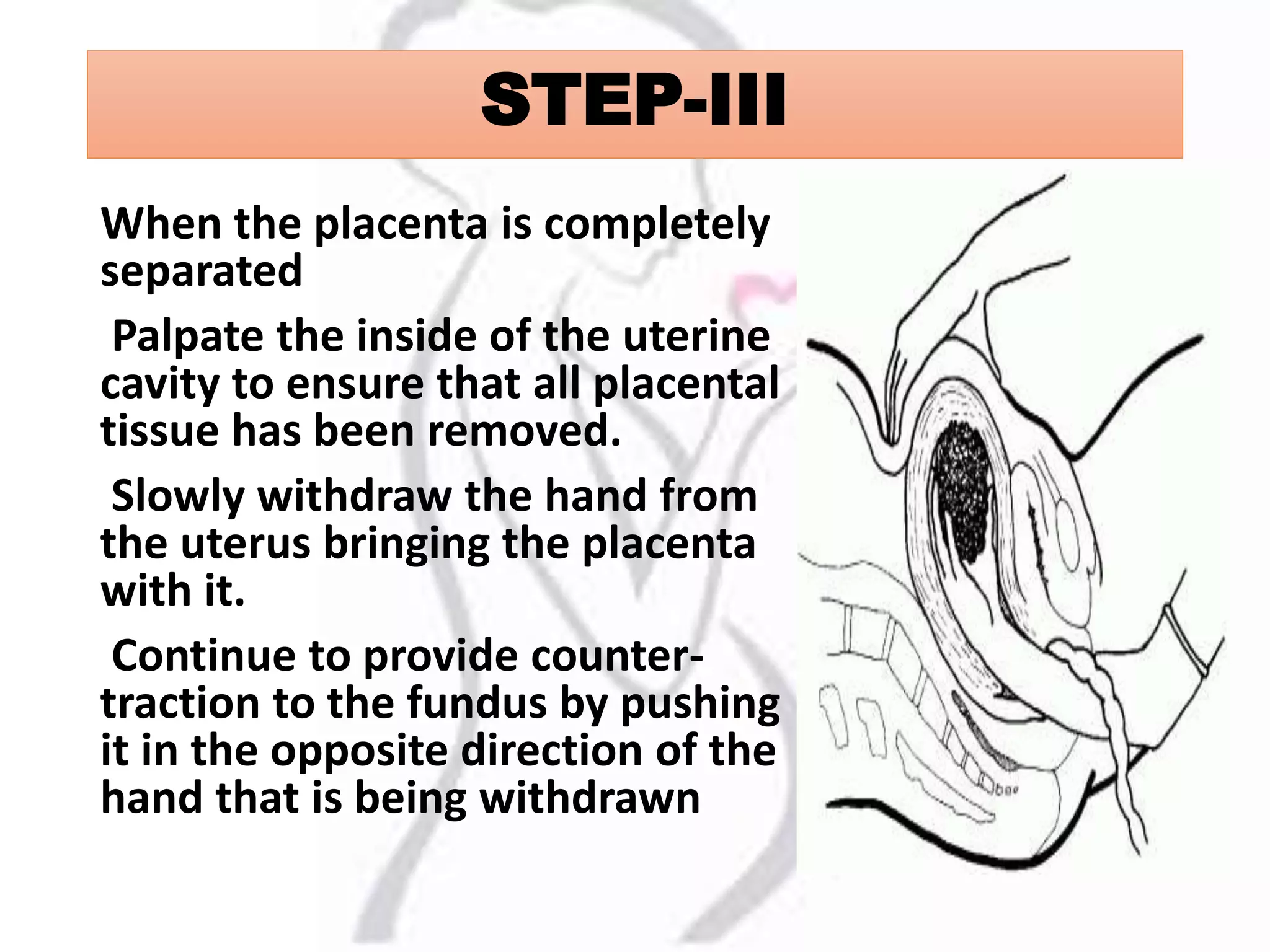 STEP-III
When the placenta is completely
separated
Palpate the inside of the uterine
cavity to ensure that all placental
tissue has been removed.
Slowly withdraw the hand from
the uterus bringing the placenta
with it.
Continue to provide counter-
traction to the fundus by pushing
it in the opposite direction of the
hand that is being withdrawn
 