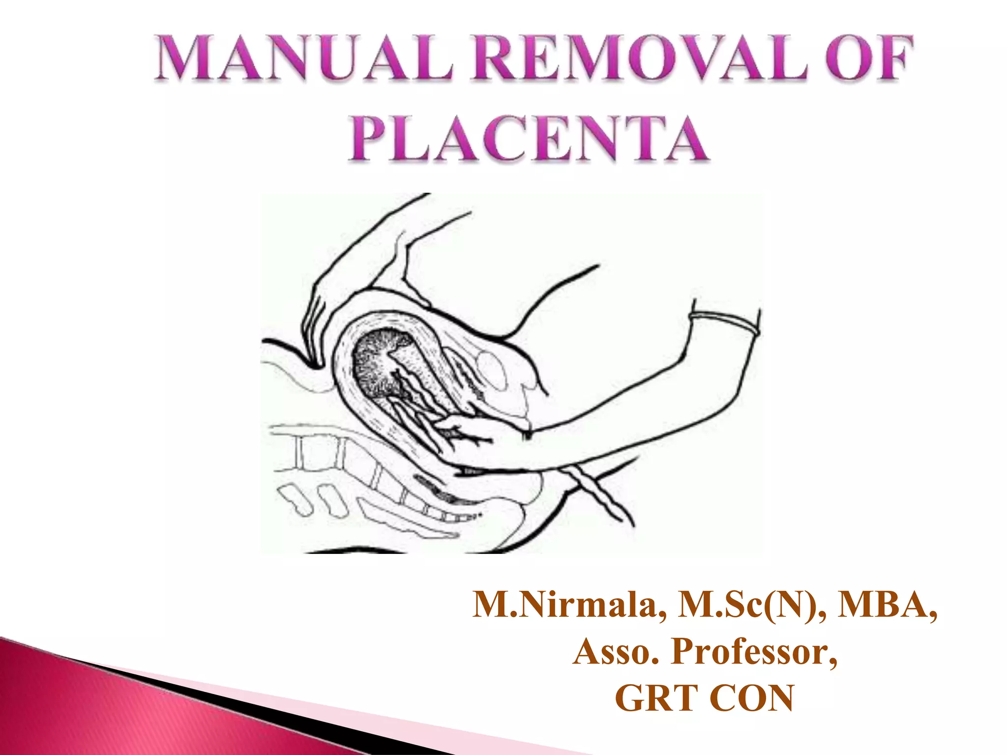 Manual removal of placenta.pptx