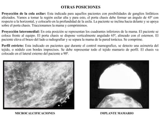 OTRAS POSICIONES Proyección de la cola axilar:  Esta indicada para aquellos pacientes con posibilidades de ganglios linfáticos afectados. Vamos a tomar la región axilar alta y para esto, el porta chasis debe formar un ángulo de 45ª con respecto a la horizontal, y colocarlo en la profundidad de la axila. La paciente se inclina hacia delante y se apoya sobre el porta chasis. Traccionamos la mama y comprimimos. Proyección lateromedial:  En esta posición se representan los cuadrantes inferiores de la mama. El paciente se coloca frente al equipo. El porta chasis se dispone verticalmente angulado 65ª, alineado con el esternon. El paciente eleva el brazo del lado a radiografiar y se separa la mama de la pared torácica. Se comprime. Perfil estricto:  Esta indicado en pacientes que durante el control mamografico, se detecto una asimetría del tejido, o nódulo con bordes imprecisos. Se debe representar todo el tejido mamario de perfil. El chasis va colocado en el lateral externo del paciente a 90ª. MICROCALCIFICACIONES IMPLANTE MAMARIO 