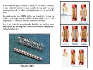 Concluido este paso, se llena el balón, de liquido de contraste y una solución salina, lo cual amplia la luz del vaso por compactación de la placa arteriosclerótica en la pared del vaso. La angioplastia con STEN, difiere de la anterior, porque se coloca  una maya metálica cilíndrica dentro del vaso, lo cual impide que la arteria se estreche en forma inmediata. En el servicio de hemodinamia También se pueden hacer  implantes de marcapasos, cierre de defectos congénitos, valvulopatias, etc. TIPOS DE STEN 