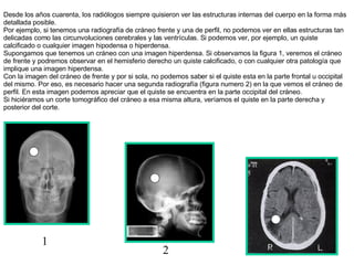 Desde los años cuarenta, los radiólogos siempre quisieron ver las estructuras internas del cuerpo en la forma más detallada posible. Por ejemplo, si tenemos una radiografía de cráneo frente y una de perfil, no podemos ver en ellas estructuras tan delicadas como las circunvoluciones cerebrales y las ventrículas. Si podemos ver, por ejemplo, un quiste calcificado o cualquier imagen hipodensa o hiperdensa. Supongamos que tenemos un cráneo con una imagen hiperdensa. Si observamos la figura  1 , veremos el cráneo de frente y podremos observar en el hemisferio derecho un quiste calcificado, o con cualquier otra patología que implique una imagen hiperdensa. Con la imagen del cráneo de frente y por si sola, no podemos saber si el quiste esta en la parte frontal u occipital del mismo. Por eso, es necesario hacer una segunda radiografía (figura numero  2 ) en la que vemos el cráneo de perfil. En esta imagen podemos apreciar que el quiste se encuentra en la parte occipital del cráneo.  Si hiciéramos un corte tomográfico del cráneo a esa misma altura, veríamos el quiste en la parte derecha y posterior del corte.   1 2 