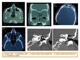 A B B C D E F A -AXIAL SPN   B -CORONAL SPN   C -AXIAL FRACTURA FRONTAL   D -AXIAL FRACTURA MALAR  E y F -CORONAL OIDO 