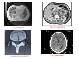 TAC DE TORAX TAC DE ABDOMEN TAC COLUMNA LUMBAR TAC DE CEREBRO 