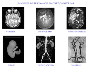 IMÁGENES DE RESONANCIA MAGNÉTICA NUCLEAR CEREBRO  ANGIO POR RMN  INFARTO CEREBRAL FETO 3D  TRONCO AÓRTICO  CAROTIDAS 