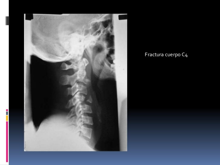 Resultado de imagen para rx de columna vertebral