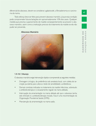 47
CADERNOSDE
ATENÇÃOBÁSICA
diferencial do abscesso, devem-se considerar a galactocele, a ﬁbroadenoma e o carcino-
ma da mama.
Todo esforço deve ser feito para prevenir abscesso mamário, já que essa condição
pode comprometer futuras lactações em aproximadamente 10% dos casos. Qualquer
medida que previna o aparecimento de mastite conseqüentemente vai prevenir o abs-
cesso mamário, assim como a instituição precoce do tratamento da mastite se ela não
puder ser prevenida.
Abscesso Mamário
1.9.10.1 Manejo
O abscesso mamário exige intervenção rápida e compreende as seguintes medidas:
Drenagem cirúrgica, de preferência sob anestesia local, com coleta de se-•
creção purulenta para cultura e teste de sensibilidade a antibióticos;
Demais condutas indicadas no tratamento da mastite infecciosa, sobretudo•
a antibioticoterapia e o esvaziamento regular da mama afetada;
Interrupção da amamentação na mama afetada até que o abscesso tenha•
sido drenado e a antibioticoterapia iniciada. Essa é uma recomendação da
Organização Mundial da Saúde (OMS);
Manutenção da amamentação na mama sadia.•
 