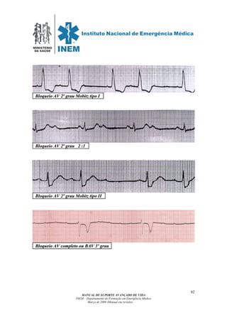 MINISTÉRIO
DA SAÚDE
MANUAL DE SUPORTE AVANÇADO DE VIDA
INEM – Departamento de Formação em Emergência Médica
Março de 2006 (Manual em revisão)
82
BBllooqquueeiioo AAVV 22ºº ggrraauu MMoobbiittzz ttiippoo II .
BBllooqquueeiioo AAVV 22ºº ggrraauu 22 ::11 .
BBllooqquueeiioo AAVV 22ºº ggrraauu MMoobbiittzz ttiippoo IIII .
BBllooqquueeiioo AAVV ccoommpplleettoo oouu BBAAVV 33ºº ggrraauu .
 