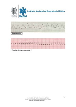 MINISTÉRIO
DA SAÚDE
MANUAL DE SUPORTE AVANÇADO DE VIDA
INEM – Departamento de Formação em Emergência Médica
Março de 2006 (Manual em revisão)
83
RRiittmmoo aaggóónniiccoo .
TTaaqquuiiccaarrddiiaa ssuupprraavveennttrriiccuullaarr .
 