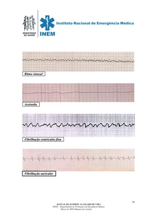 MINISTÉRIO
DA SAÚDE
MANUAL DE SUPORTE AVANÇADO DE VIDA
INEM – Departamento de Formação em Emergência Médica
Março de 2006 (Manual em revisão)
79
RRiittmmoo ssiinnuussaall .
AAssssiissttoolliiaa .
FFiibbrriillhhaaççããoo vveennttrriiccuullaarr ffiinnaa .
FFiibbrriillhhaaççããoo aauurriiccuullaarr
 