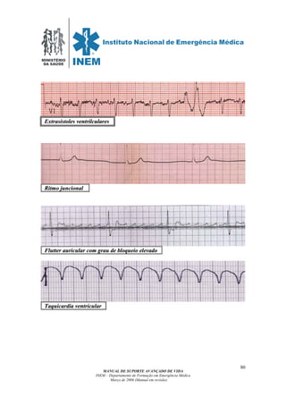 MINISTÉRIO
DA SAÚDE
MANUAL DE SUPORTE AVANÇADO DE VIDA
INEM – Departamento de Formação em Emergência Médica
Março de 2006 (Manual em revisão)
80
RRiittmmoo jjuunncciioonnaall .
FFlluutttteerr aauurriiccuullaarr ccoomm ggrraauu ddee bbllooqquueeiioo eelleevvaaddoo .
TTaaqquuiiccaarrddiiaa vveennttrriiccuullaarr .
EExxttrraassiissttoolleess vveennttrriillccuullaarreess
 