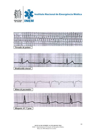 MINISTÉRIO
DA SAÚDE
MANUAL DE SUPORTE AVANÇADO DE VIDA
INEM – Departamento de Formação em Emergência Médica
Março de 2006 (Manual em revisão)
81
TToorrssaaddeess ddee ppooiinntteess .
BBrraaddiiccaarrddiiaa ssiinnuussaall .
RRiittmmoo ddee ppaacceemmaakkeerr .
BBllooqquueeiioo AAVV 11ºº ggrraauu .
 