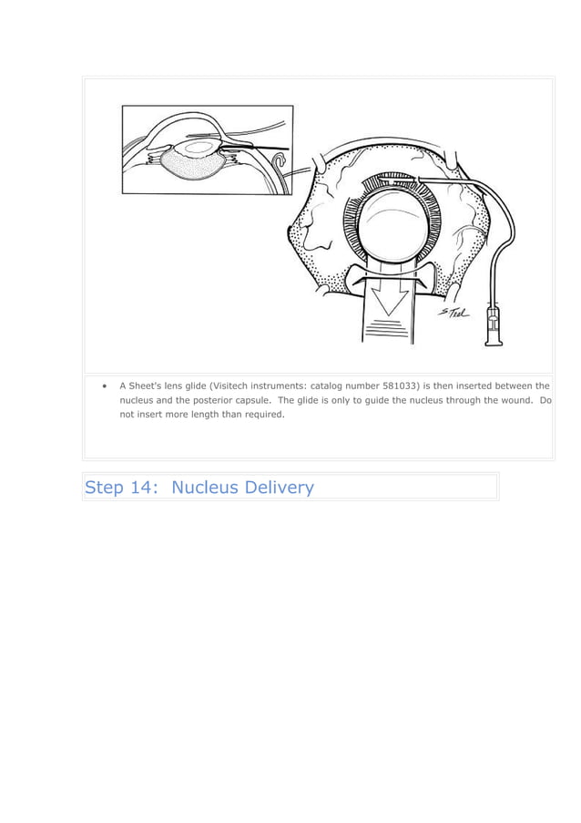 Manual small incision cataract surgery | DOC