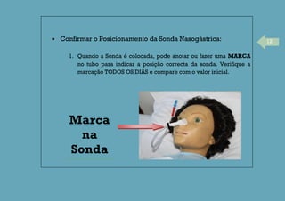 12Confirmar o Posicionamento da Sonda Nasogástrica:
1. Quando a Sonda é colocada, pode anotar ou fazer uma MARCA
no tubo para indicar a posição correcta da sonda. Verifique a
marcação TODOS OS DIAS e compare com o valor inicial.
Marca
na
Sonda
 