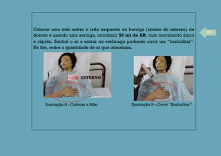 15
Colocar uma mão sobre o lado esquerdo da barriga (abaixo do esterno) do
doente e usando uma seringa, introduzir 50 ml de AR, num movimento único
e rápido. Sentirá o ar a entrar no estômago podendo ouvir um “borbulhar”.
No fim, retire a quantidade de ar que introduziu.
Ilustração 8 - Colocar a Mão Ilustração 9 – Ouvir “Borbulhar”
ESTERNO
 
