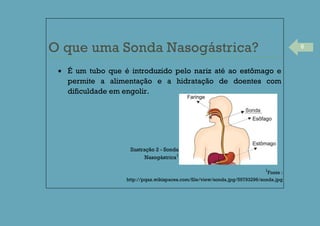 6
O que uma Sonda Nasogástrica?
É um tubo que é introduzido pelo nariz até ao estômago e
permite a alimentação e a hidratação de doentes com
dificuldade em engolir.
1
Fonte :
http://pqax.wikispaces.com/file/view/sonda.jpg/59793296/sonda.jpg
Ilustração 2 - Sonda
Nasogástrica1
 